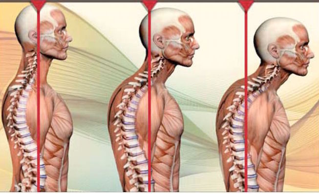 Forward Head Posture
